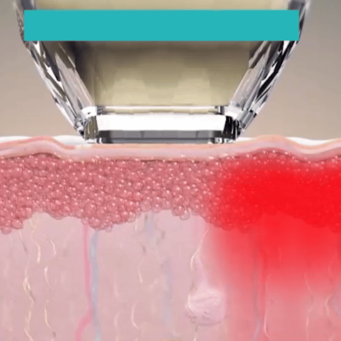 맞춤 고주파 레이저: 비침습형 고주파