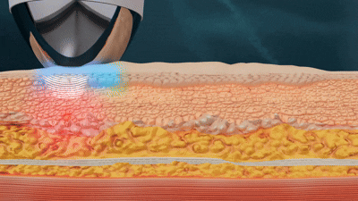 10Hz 집속초음파