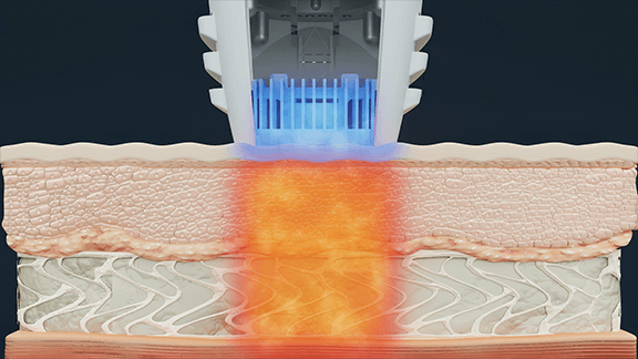 냉각 시스템으로 피부 표면 보호