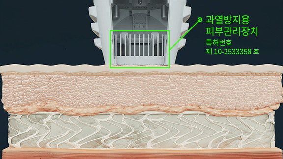 시술 시간 부담 감소